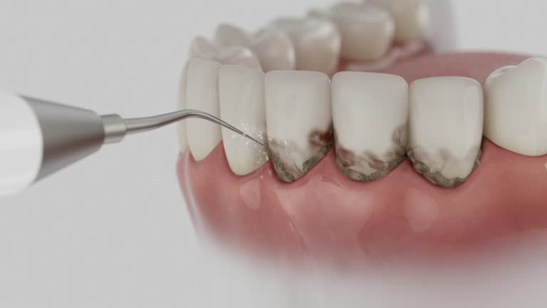 Trusted Wisdom Tooth Removal service in Bellevue, NE - Dentist Open Now